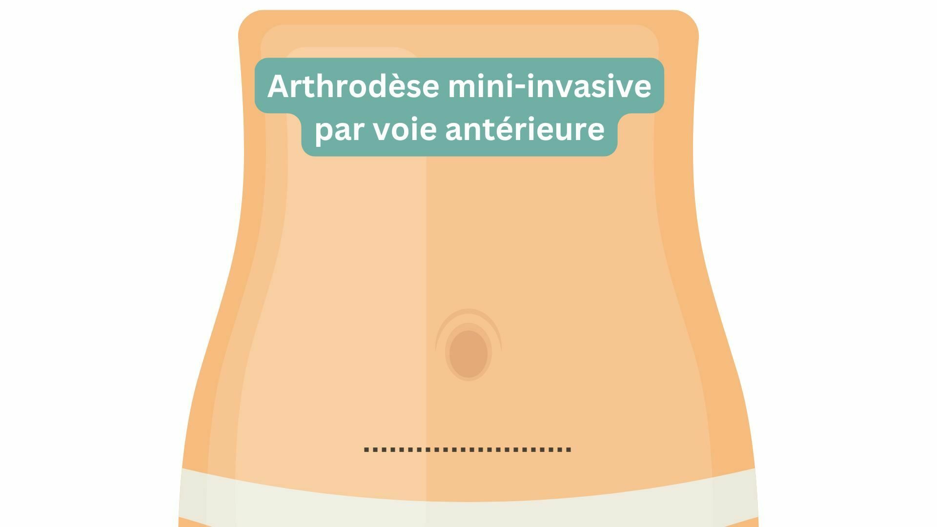 Arthrodèse mini invasive antérieure