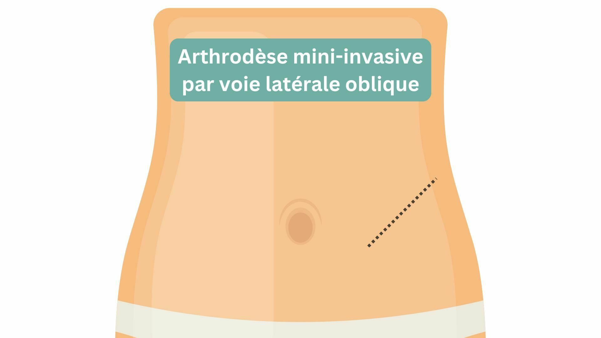 Arthrodèse mini invasive oblique