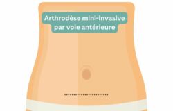 Arthrodèse mini invasive antérieure