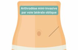 Arthrodèse mini invasive oblique